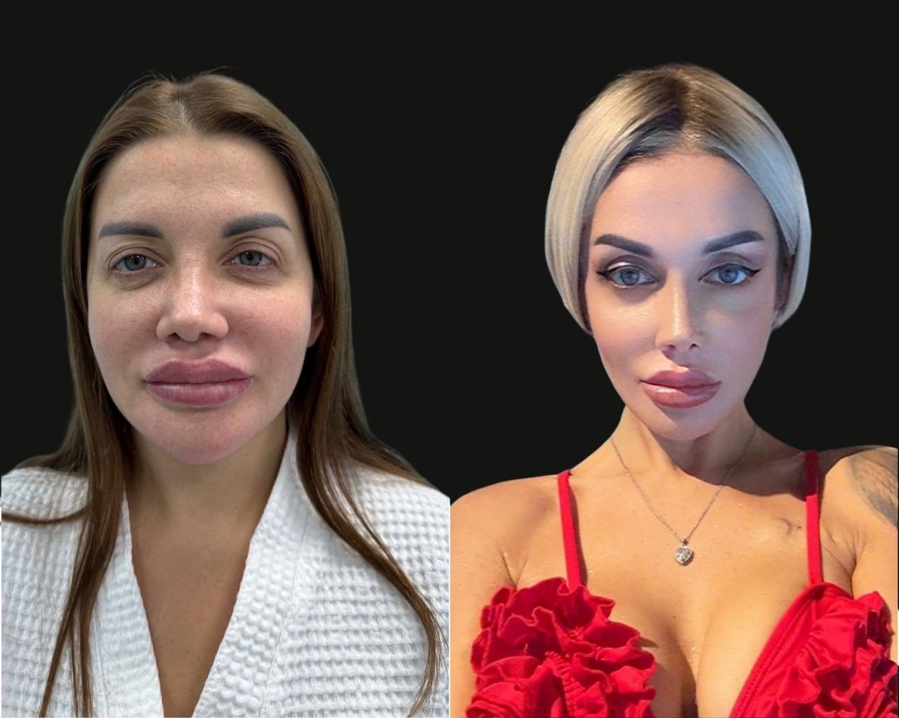 До и после — Липофилинг лица